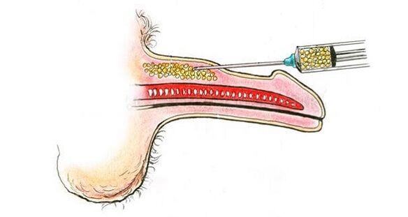 Inxeccións de ácido hialurónico no barril dun membro para aumentalo